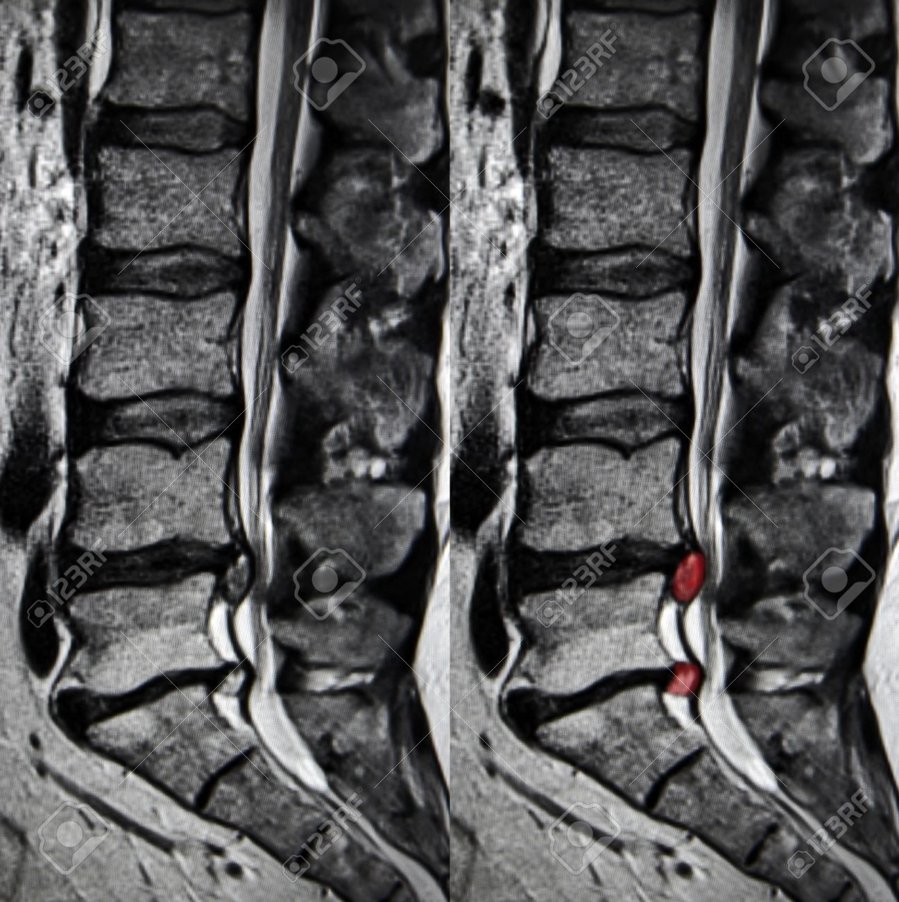 precio de una resonancia magnetica lumbar precio de una resonancia magnetica lumbar