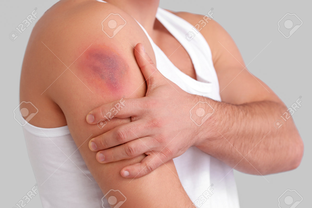 https://previews.123rf.com/images/serezniy/serezniy2301/serezniy230111823/196495015-man-with-bruise-on-shoulder-against-light-background-closeup.jpg