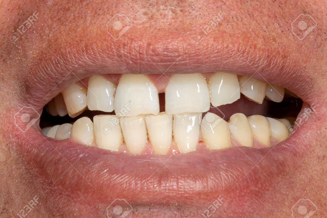 the teeth close-up after hygiene and bleaching. Man's face and smile - 123248534 the teeth close-up after hygiene and bleaching. Man's face and smile - 123248534