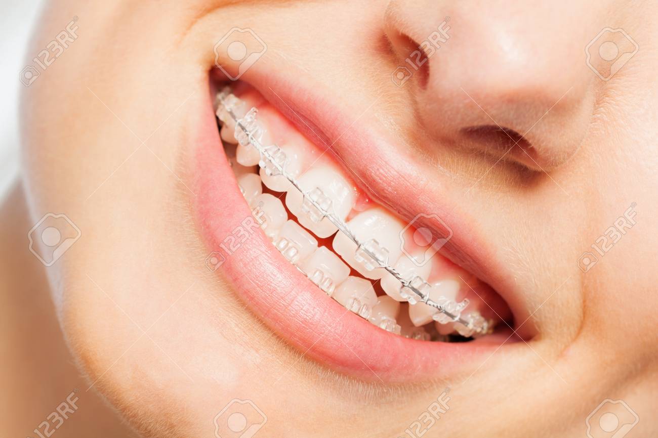 Happy smile of young woman with dental braces - 90267824 Happy smile of young woman with dental braces - 90267824