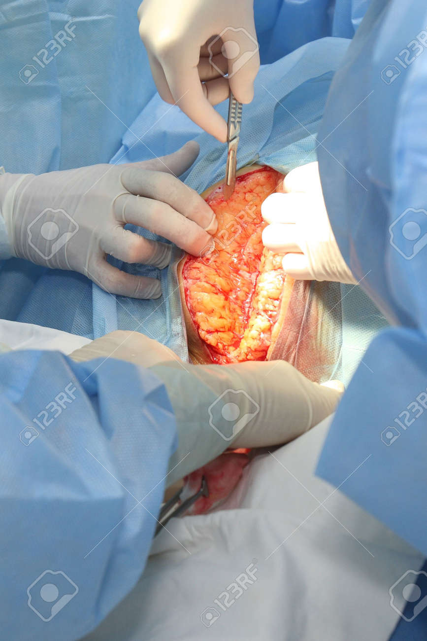 new baby being born during cesarean section stock photo picture and