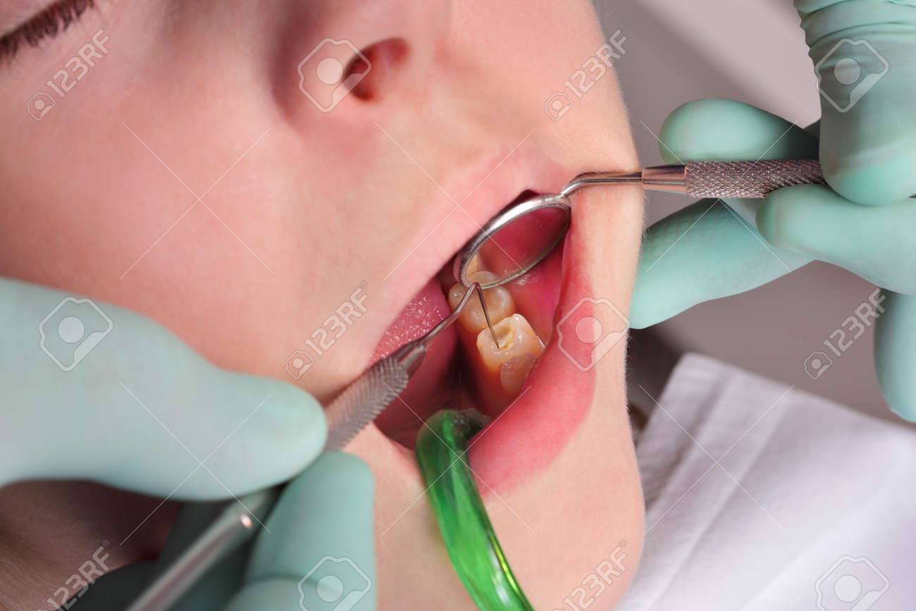 Schliessen Von Loch Hohlraum In Zahn Nach Dem Bohren Mit Dem Fullen Dentalwerkzeug Und Spiegel Lizenzfreie Fotos Bilder Und Stock Fotografie Image 73049628