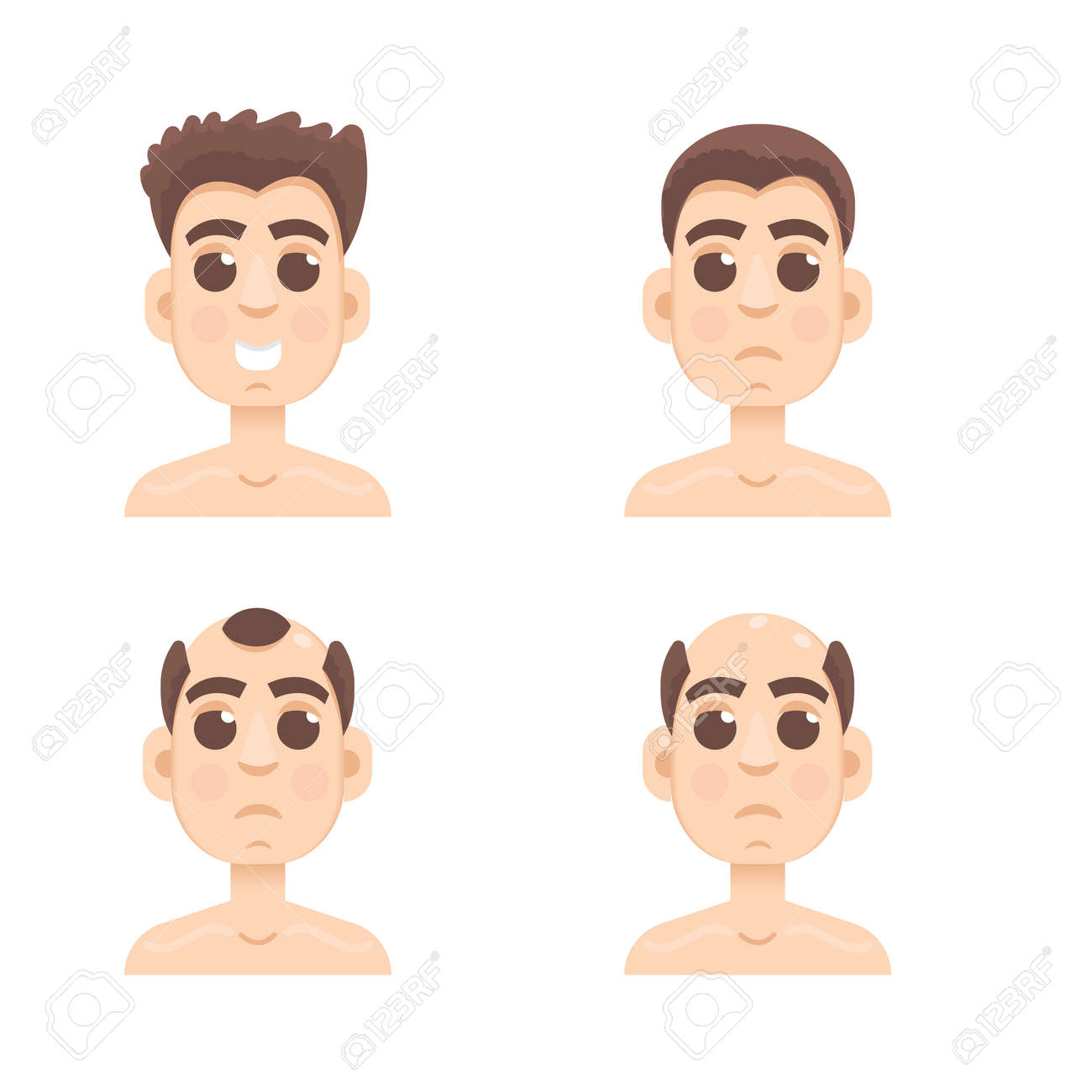 Hair Stages Loss Types Of Baldness On Male Head Vector Royalty
