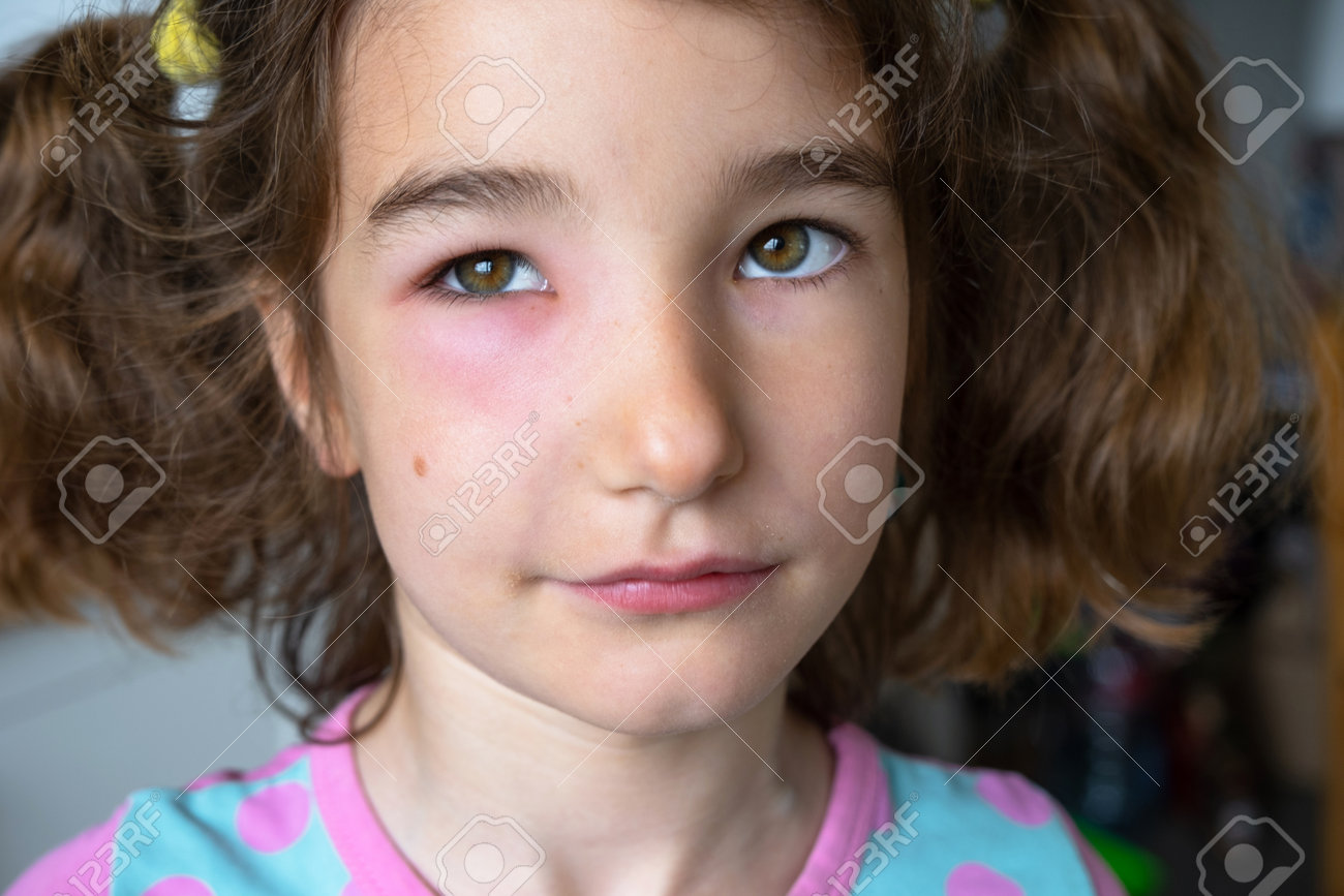 子供の顔の赤い腫れたまぶたの接写は、吸血昆虫に対する虫刺されアレルギー反応に対するアレルギーですの写真素材・画像素材 Image 209512907