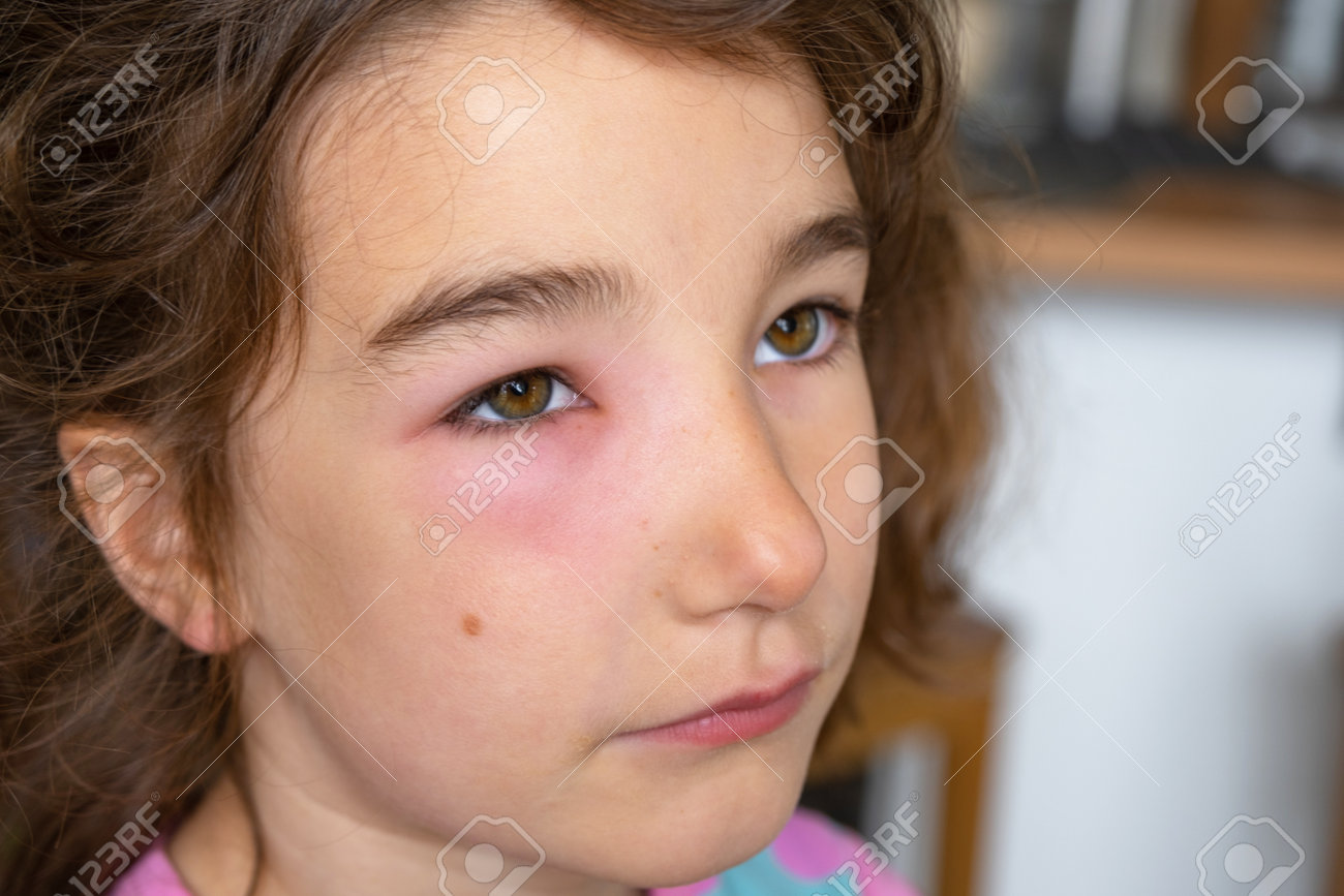 子供の顔のまぶたが赤く腫れているのは、虫刺されアレルギー、吸血昆虫に対するアレルギー反応ですの写真素材・画像素材 Image 209513420