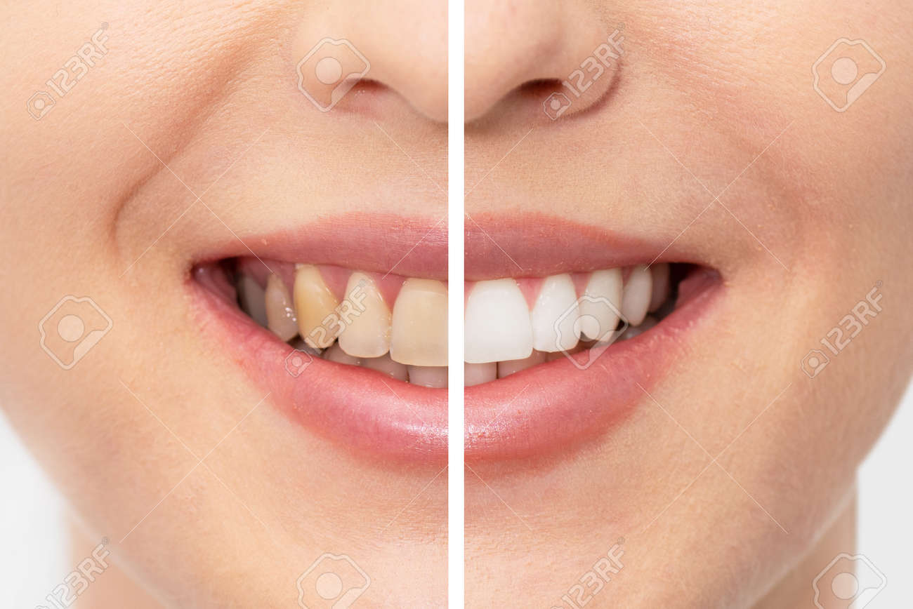Teeth before and after whitening. Dental care concept - 153667458 Teeth before and after whitening. Dental care concept - 153667458