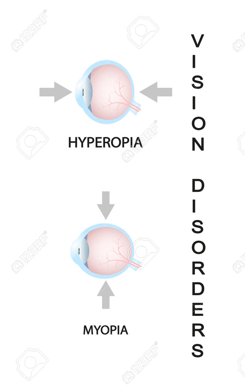Vision minus 1 - what does it mean, can Myopia be cured - is it minus or plus 27 Vision minus 1 - what does it mean, can Myopia be cured - is it minus or plus 87