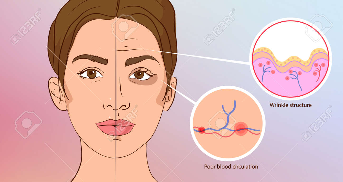 時期尚早のしわ 美容 目の前であざは 皮膚の老化 のイラスト素材 ベクタ Image 0484