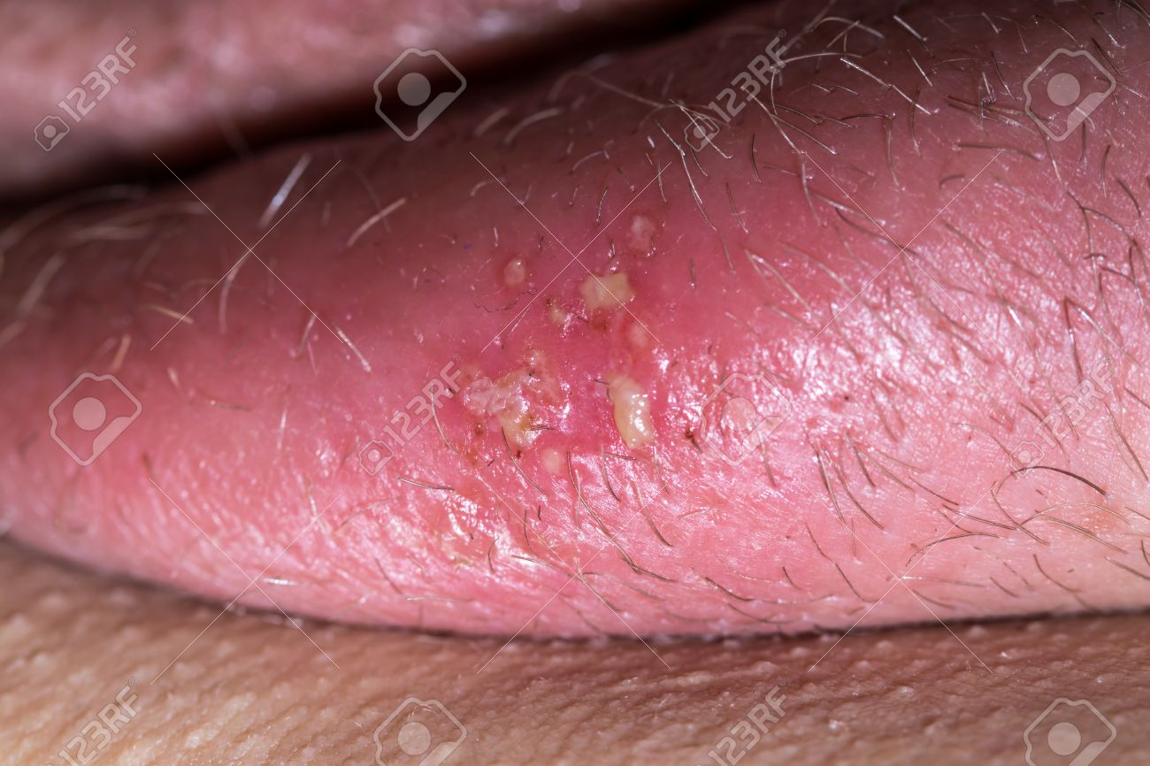 Genital Herpes (HSV-2) Pictures STD Information Genital Herpes (HSV-2) Pictures STD Information