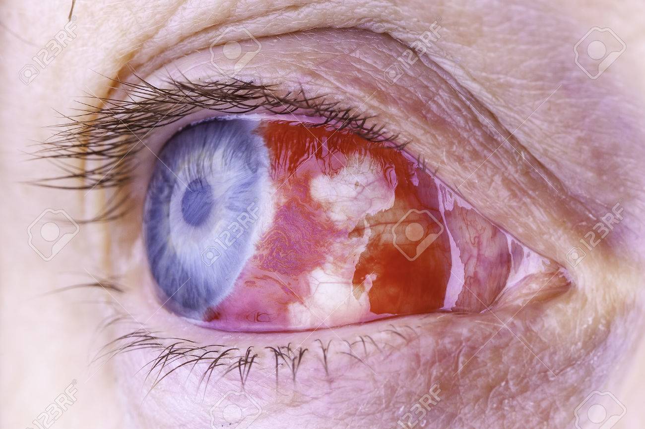 非常に赤と血走った目のショットをクローズ アップ マクロ レンズで撮影した 画像眼内血まんじの抽象的なパターンを示しています の写真素材 画像素材 Image