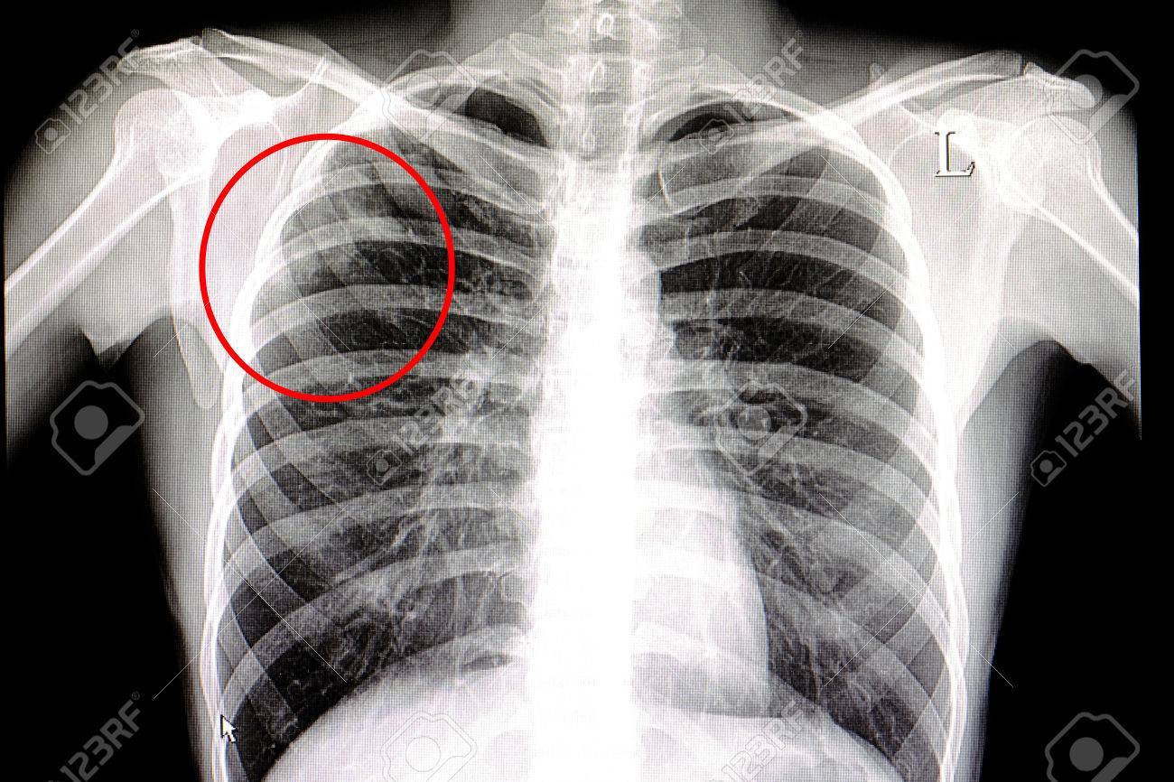Xray Film Of A Patient With Pulmonary Tuberculosis Stock Photo, Picture and  Royalty Free Image. Image 85157473., image size:1300x866
