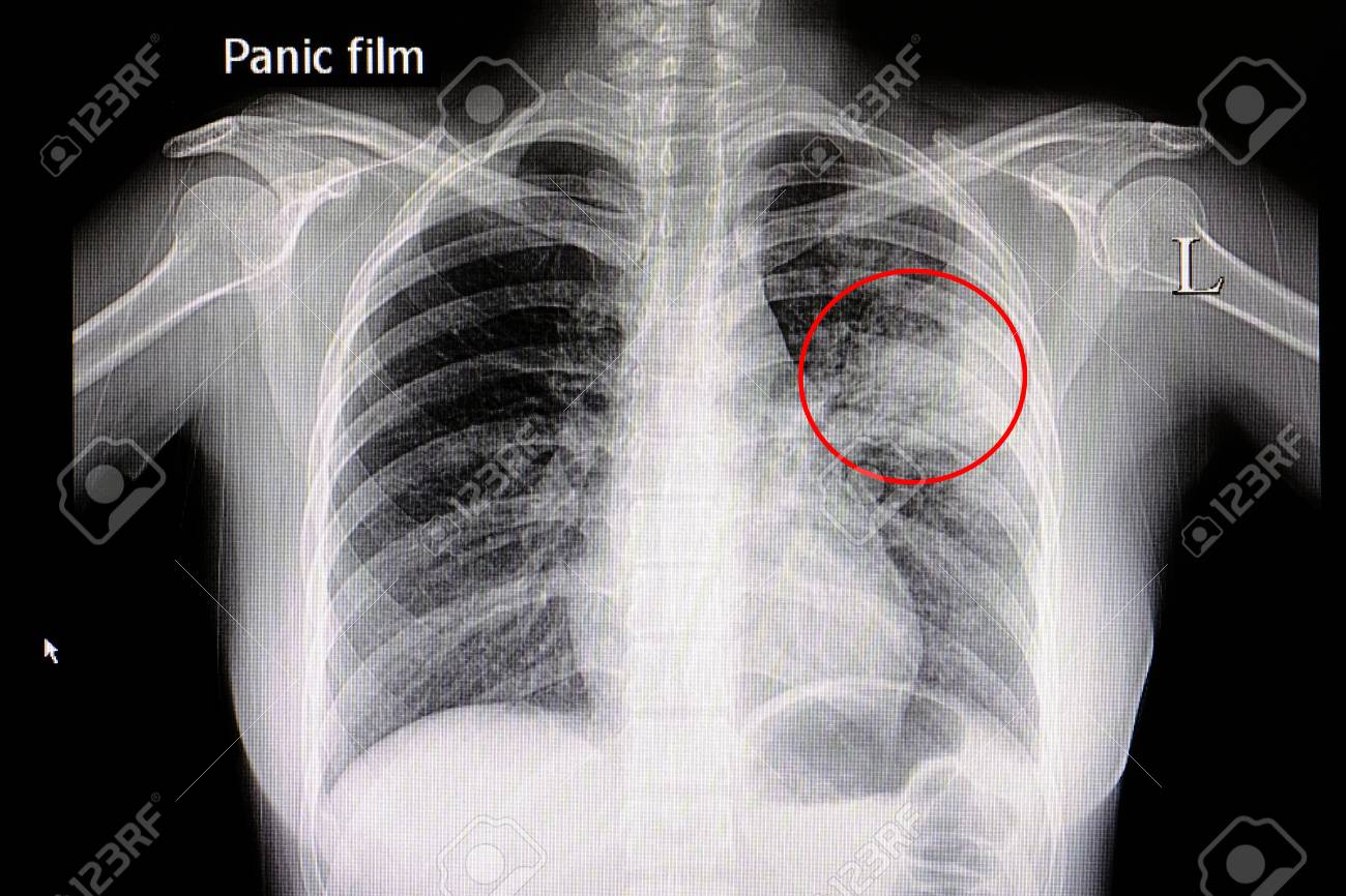 Xray film of a patient with pneumonia in his left middle lung - 85251856 Xray film of a patient with pneumonia in his left middle lung - 85251856