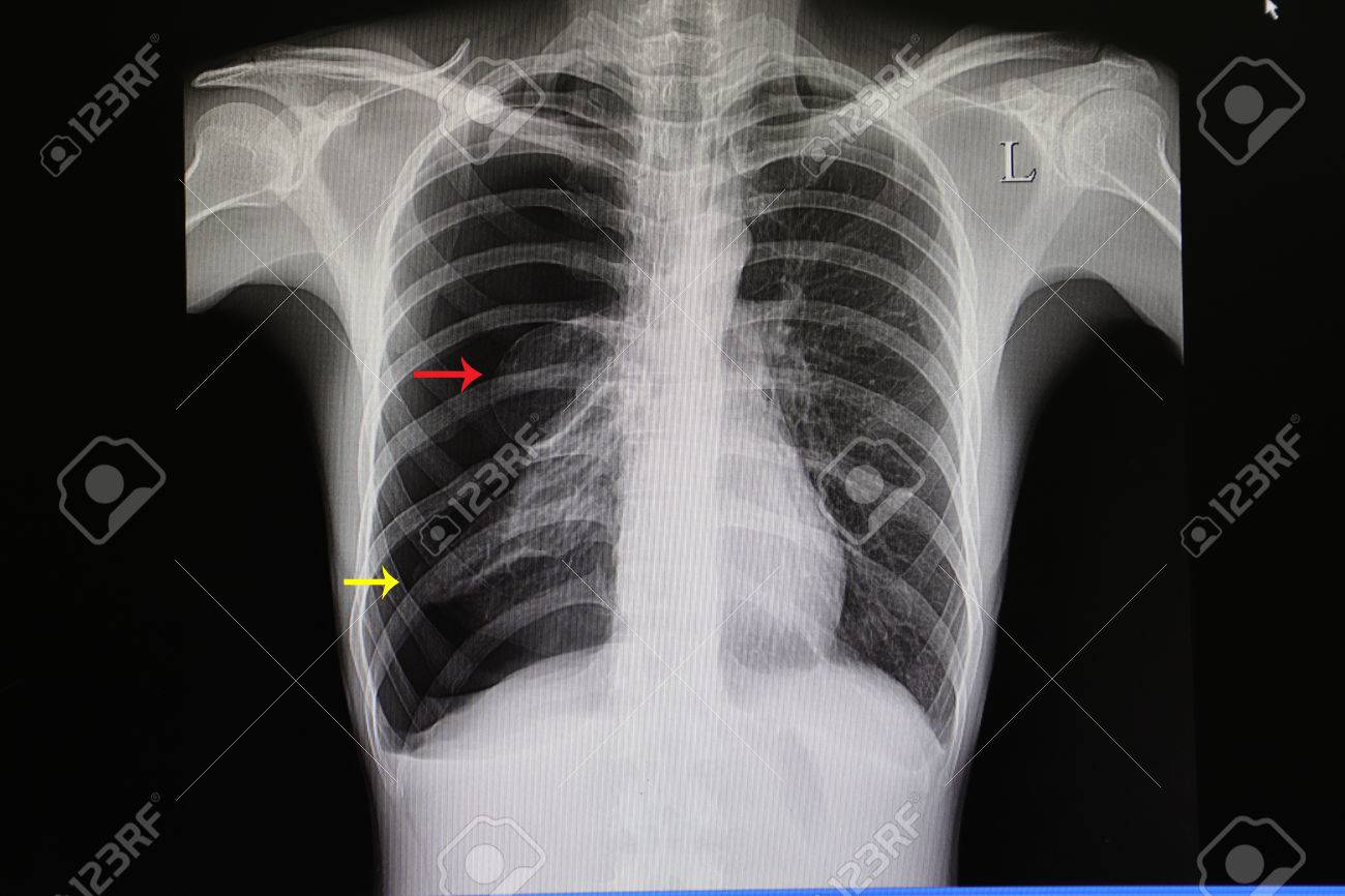 大きなほぼ総右肺気胸患者の胸部 X 線写真の崩壊 黄色の矢印 肺ブレブ 赤 Arfrow をも表示されます の写真素材 画像素材 Image