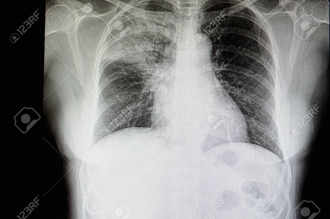 a chest xray film