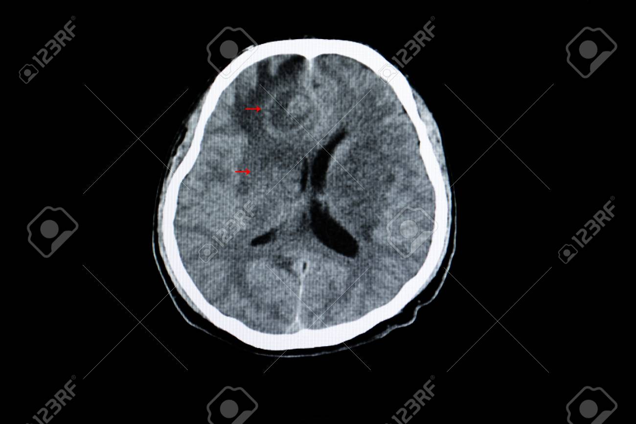 toxoplasmosis brain mri toxoplasmosis brain mri