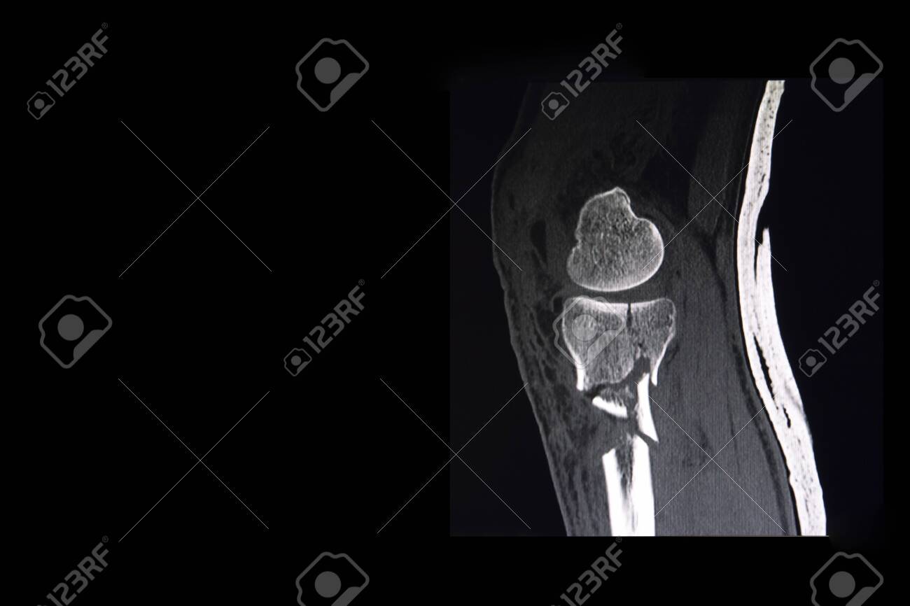 ct scan of a knee of the patient showing comminuted fracture comminuted fracture
