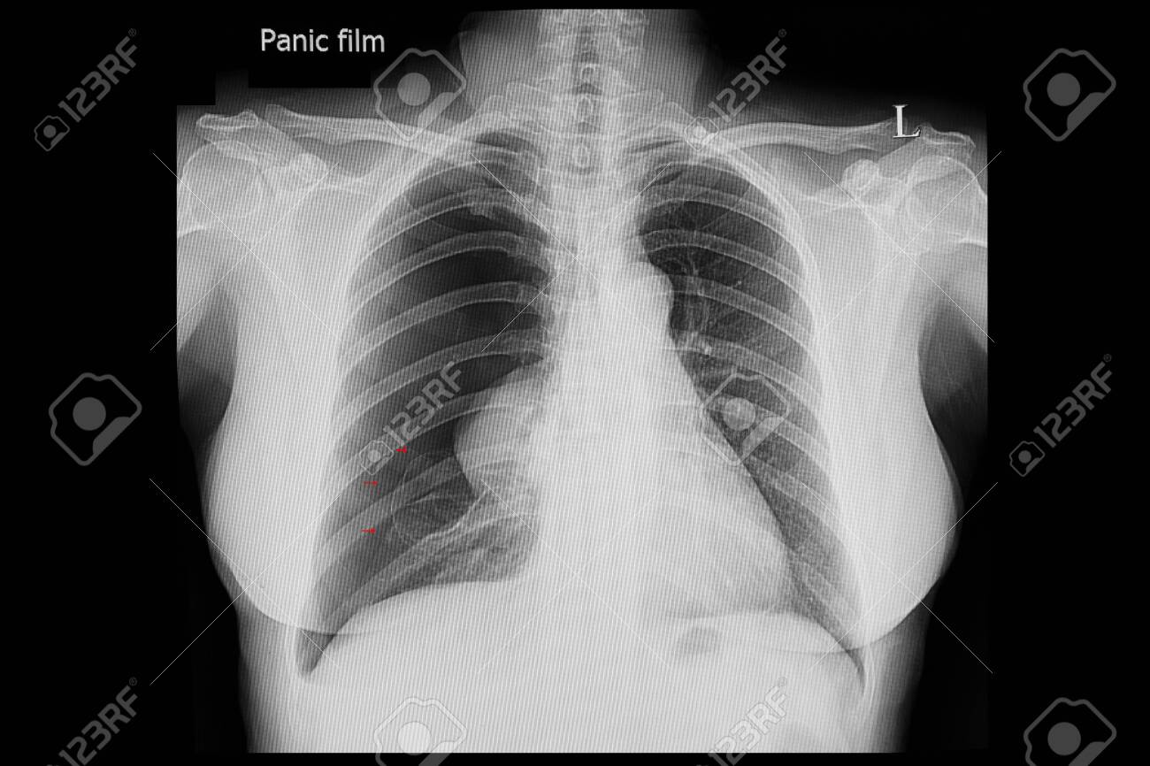 chest x ray film of a patient with spontaneous pneumothorax showing pneumothorax x ray