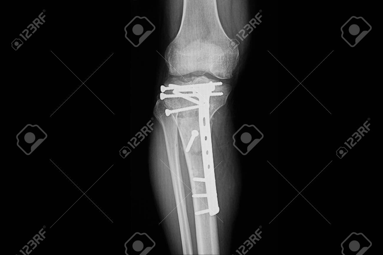 Xray film of a patient leg showing repaired fractured proximal..
