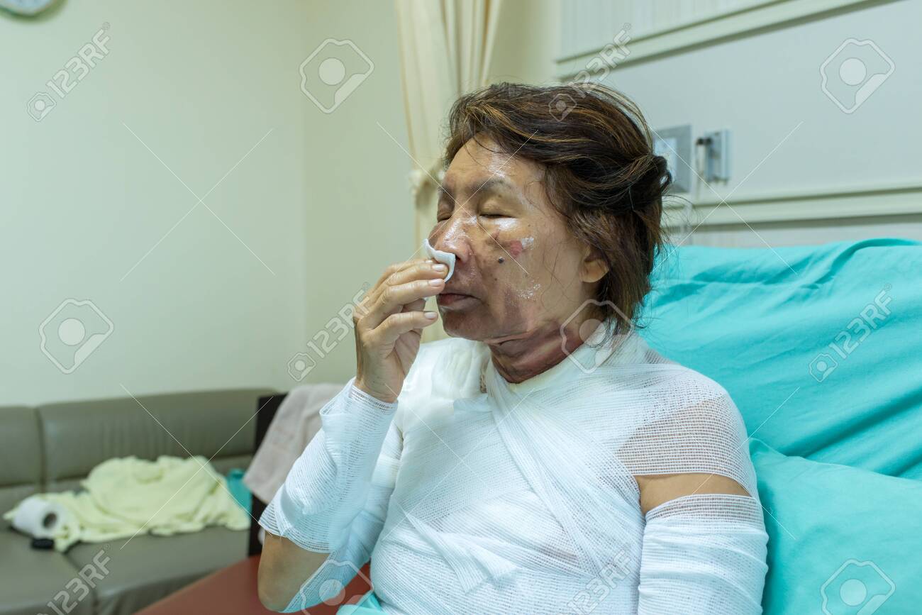 Nursing care and treatment for patient at burn unit in hospital. - 119738841 Nursing care and treatment for patient at burn unit in hospital. - 119738841