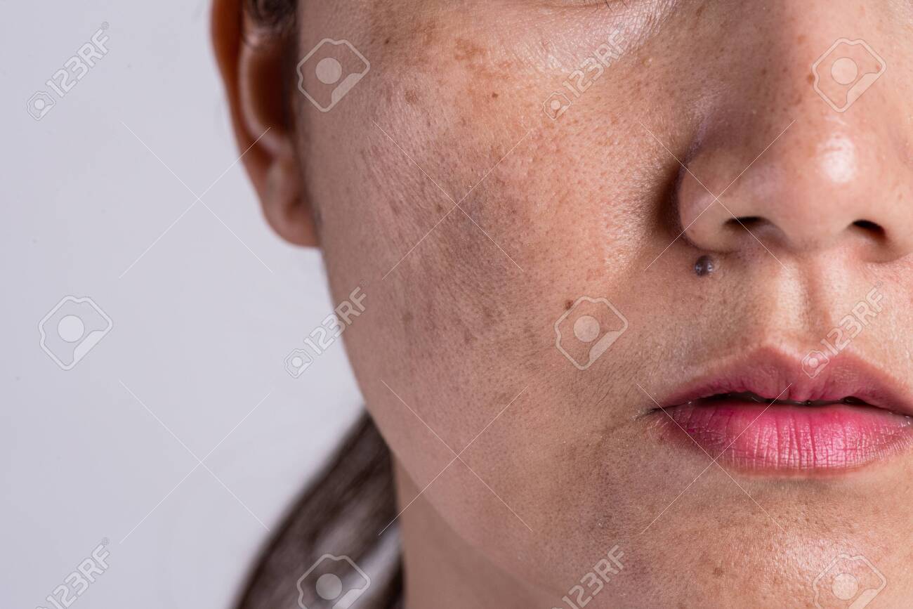 dry acne scars