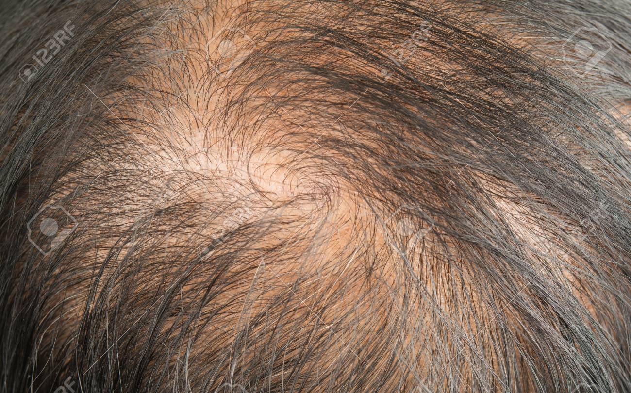 薄い髪と頭皮と壊れた髪 の写真素材 画像素材 Image