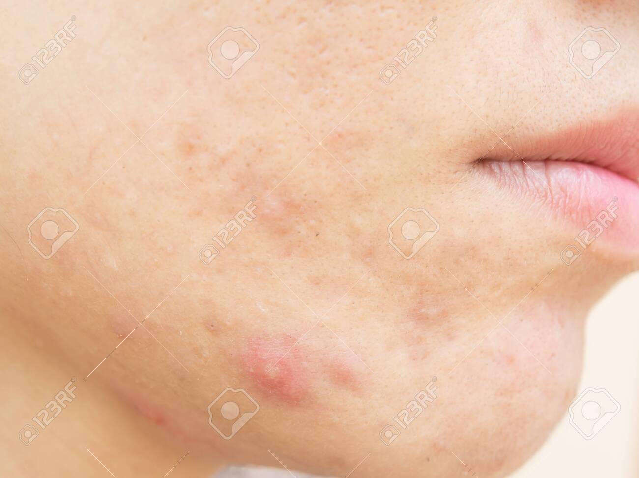 Acne Scars And Pores Dark Spots Wrinkles And Skin Problems Pores And Acne Marks Facial Skin Problems And Beauty Stock Photo Picture And Royalty Free Image Image 137639265