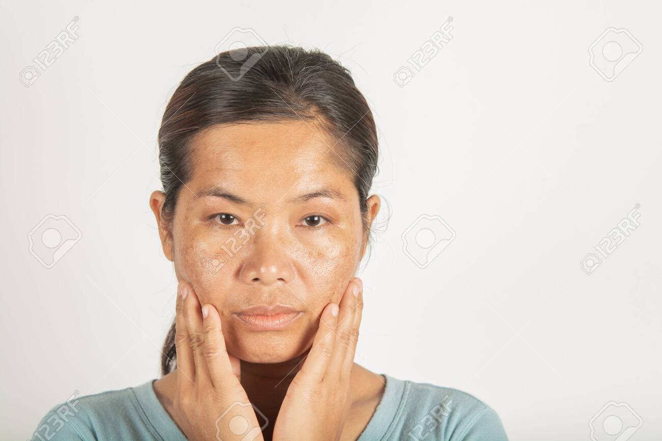 melasma facial