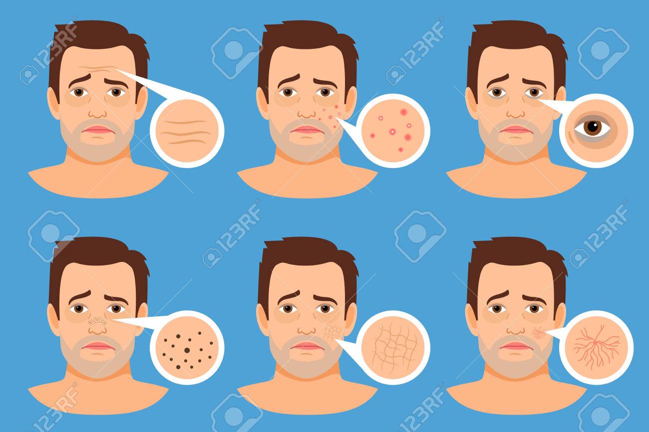 como eliminar manchas oscuras por acne como eliminar manchas oscuras por acne