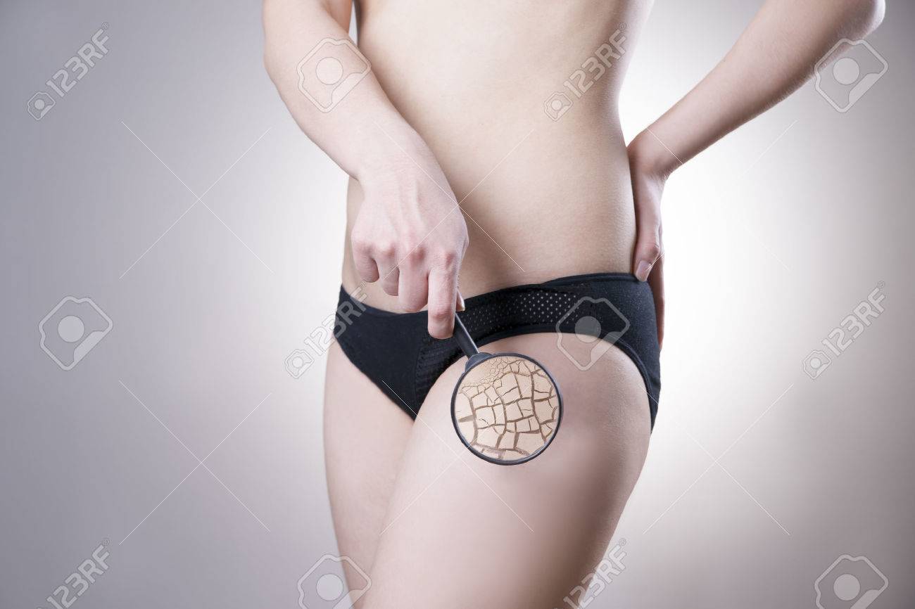 脂肪の多い女性の腰 スキンケア セルライト 肥満 の写真素材 画像素材 Image