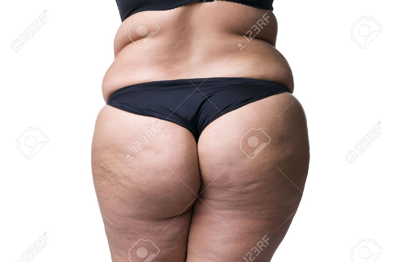 Fat Cellulite Butts Fat Cellulite Butts