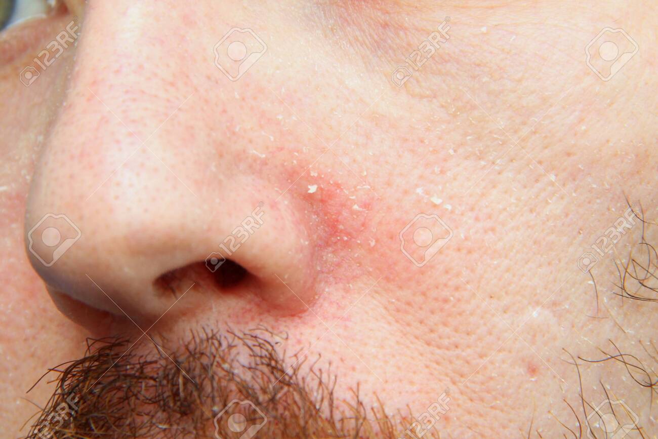 Part Of The Face With The Nose Of An Adult White Man With Dry Stock Photo Picture And Royalty Free Image Image 142522599