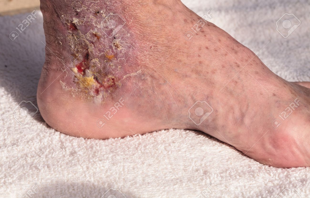 cellulitis infectie cellulitis infectie