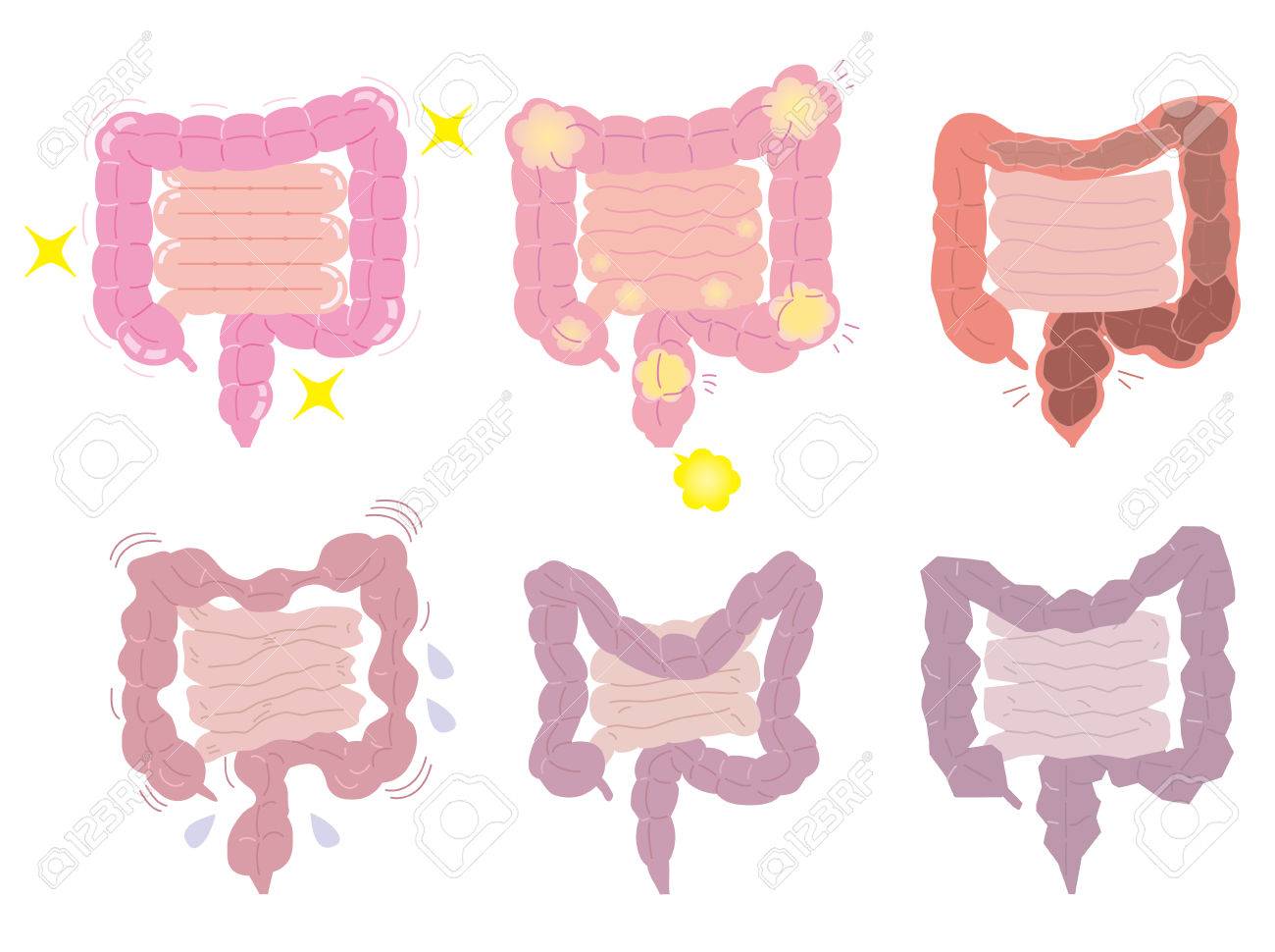 健康な腸と不健康な腸 のイラスト素材 ベクタ Image