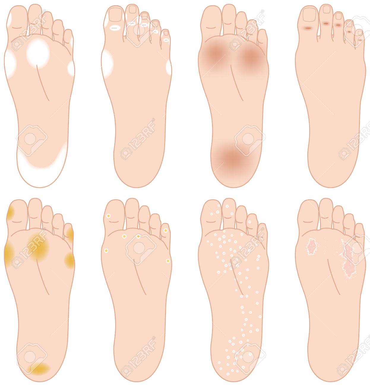 足の裏のトラブル 水虫など のイラスト素材 ベクタ Image