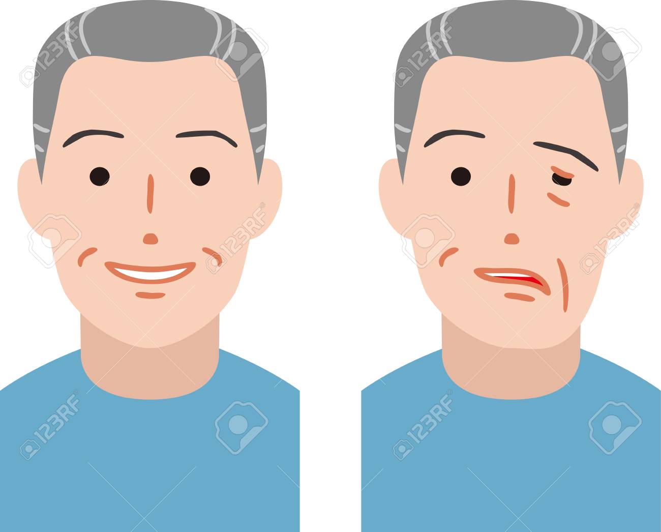 Senior citizen of facial nerve palsy - 108472638 Senior citizen of facial nerve palsy - 108472638
