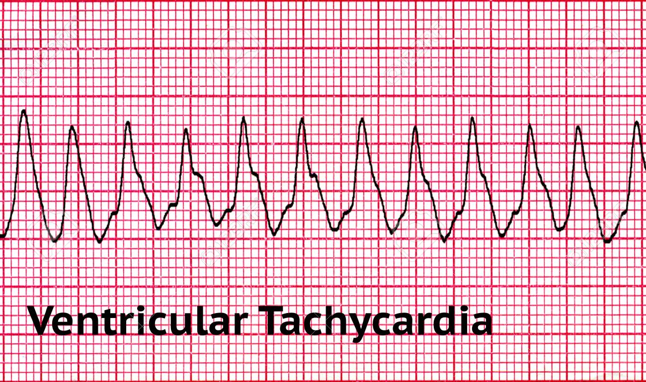 DI TACHICARDIA SCARICARE