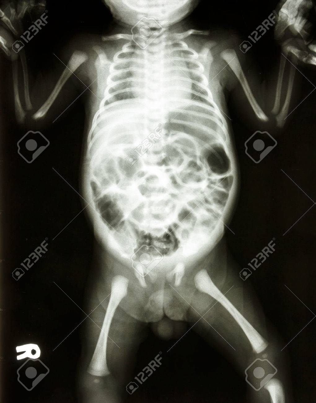 Film Radiographique Spectacle Squelette Normal De Bebe Banque D Images Et Photos Libres De Droits Image 25407941