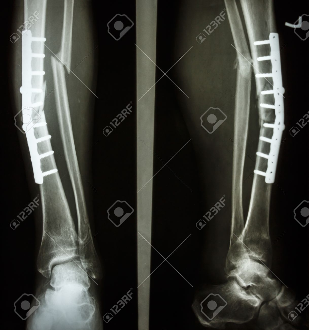 Film Leg Ap Lateral Show Fracture Shaft Of Tibia And Fibular Stock Photo Picture And Royalty Free Image Image 25799357