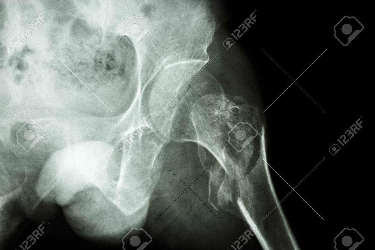 film x ray show intertrochanteric fracture left femur intertrochanteric fracture