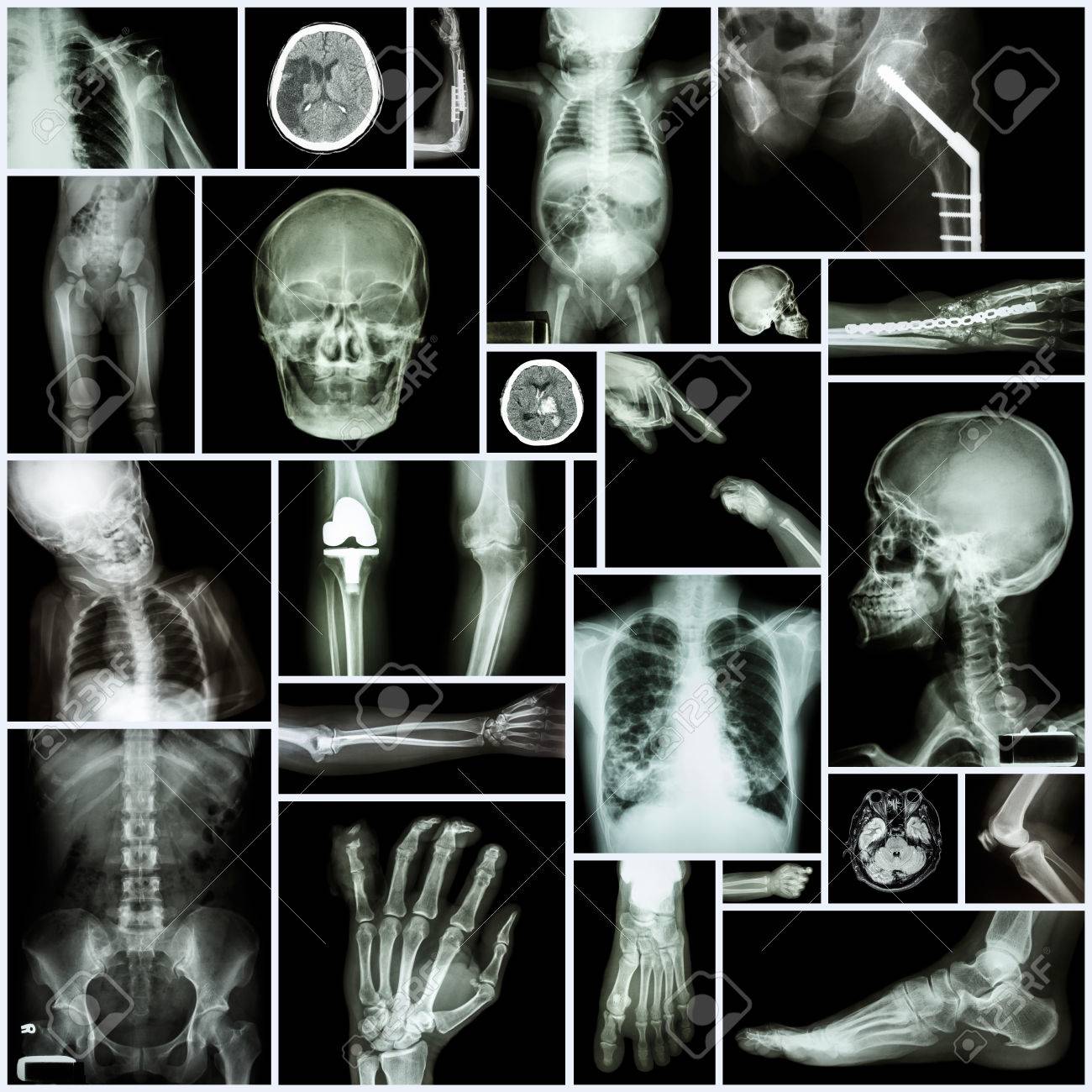 Fractura cerebral
