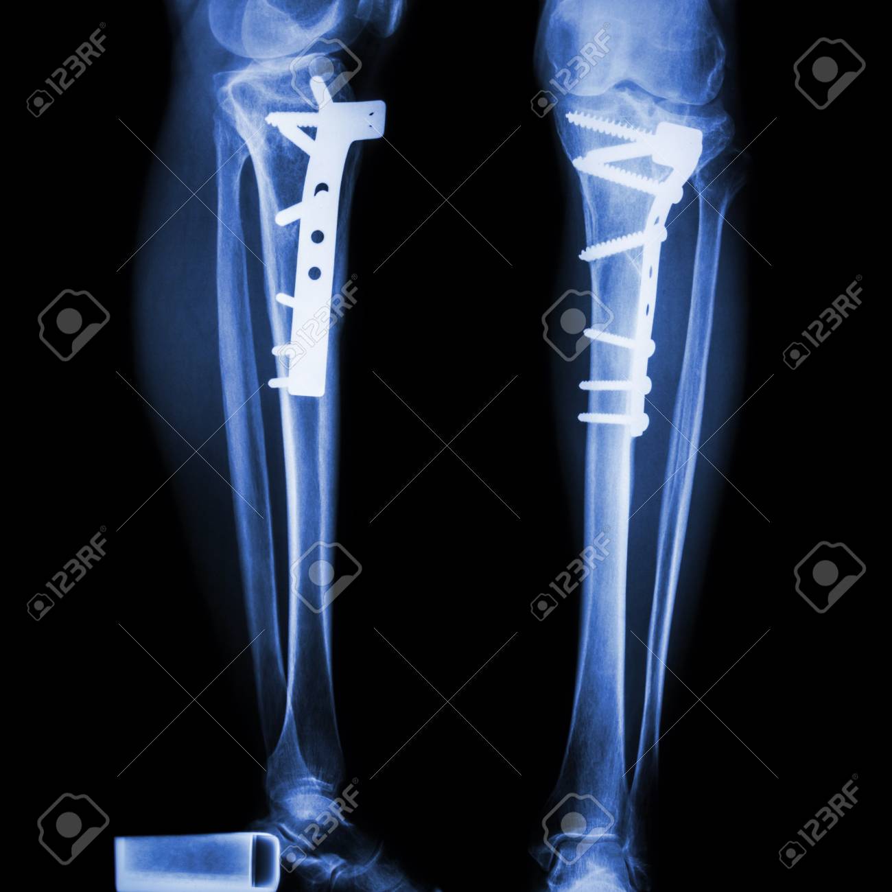 Fracture Tibia Leg Bone It Was Operated And Internal Fixed Stock Photo Picture And Royalty Free Image Image 32691931