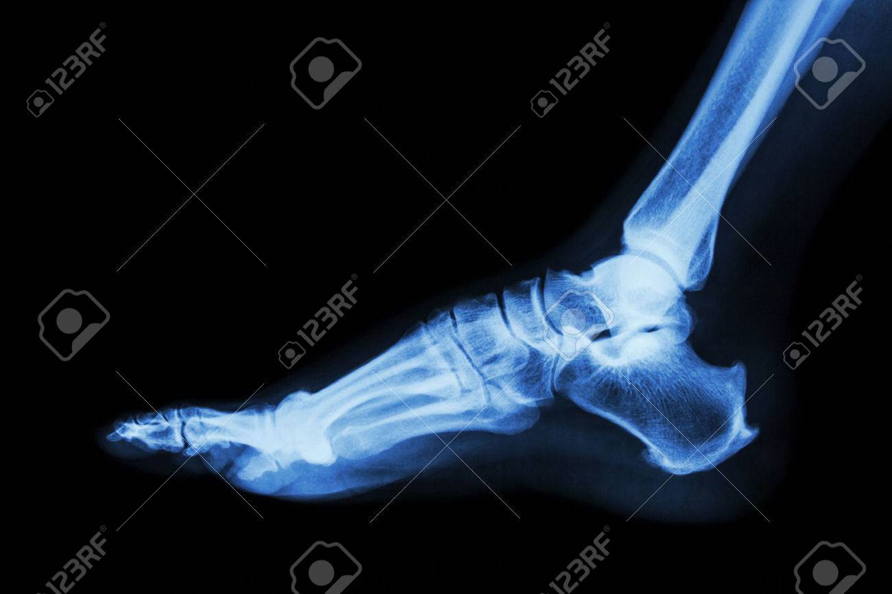 Radiographie Laterale Du Pied Normal Banque D Images Et Photos Libres De Droits Image