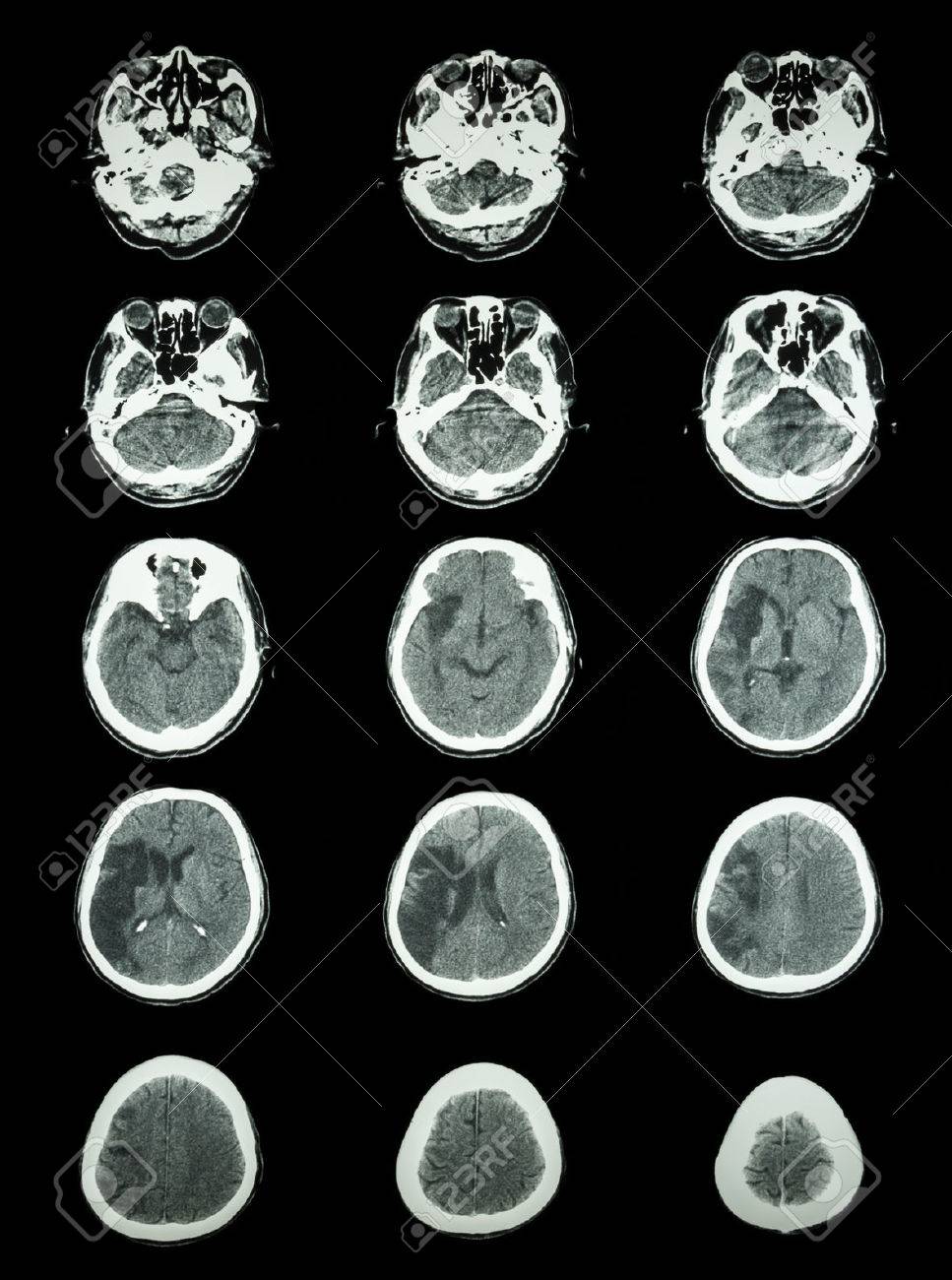 脳の Ct スキャン コンピューター断層撮影 が右頭頂側頭葉 脳梗塞 で脳梗塞を表示します の写真素材 画像素材 Image 脳の Ct スキャン コンピューター断層撮影 が右頭頂側頭葉 脳梗塞 で脳梗塞を表示します の写真素材 画像素材 Image