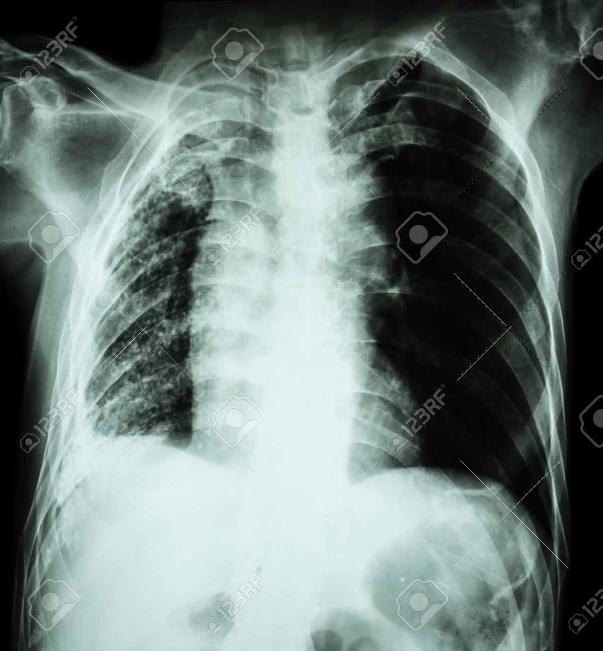 肺結核 胸部 X 線 無気肺と浸潤と結核菌感染による胸水 の写真素材 画像素材 Image