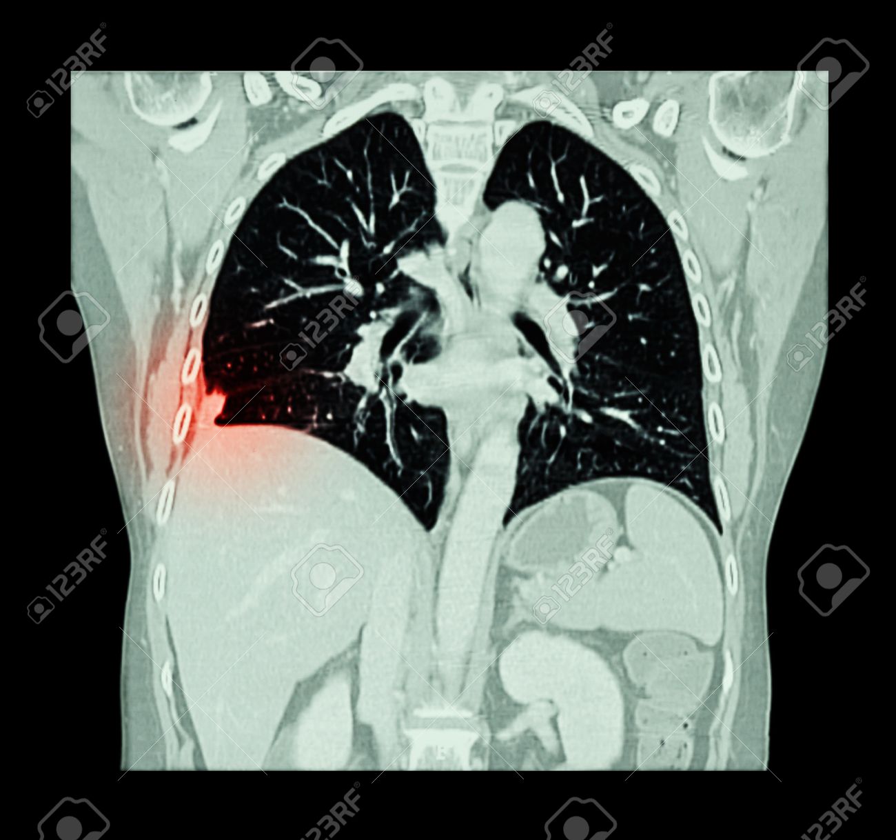 肺癌 胸部と腹部の Ct スキャン 右肺癌を表示 コロナの平面 の写真素材 画像素材 Image