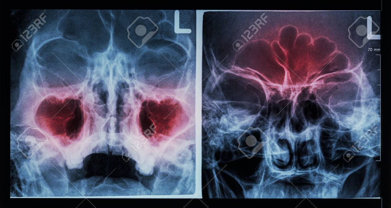 film x ray paranasal sinus show sinusitis at maxillary sinus maxillary sinus