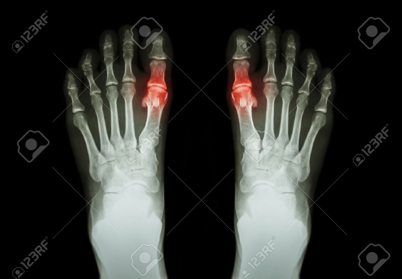 Gout , Rheumatoid arthritis ( Film x,ray both foot and arthritis..
