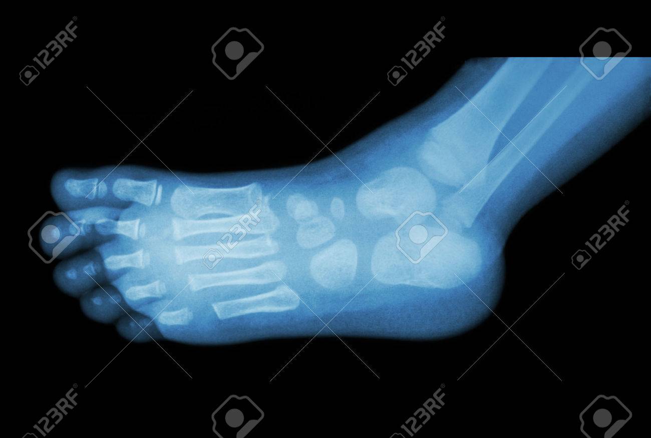 film x-ray of child 's foot ( side view ) ( lateral ) - 44559427 film x-ray of child 's foot ( side view ) ( lateral ) - 44559427
