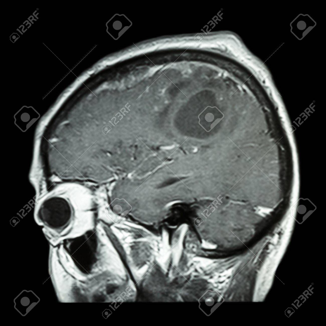 Resonancia que cerebral es magnetica
