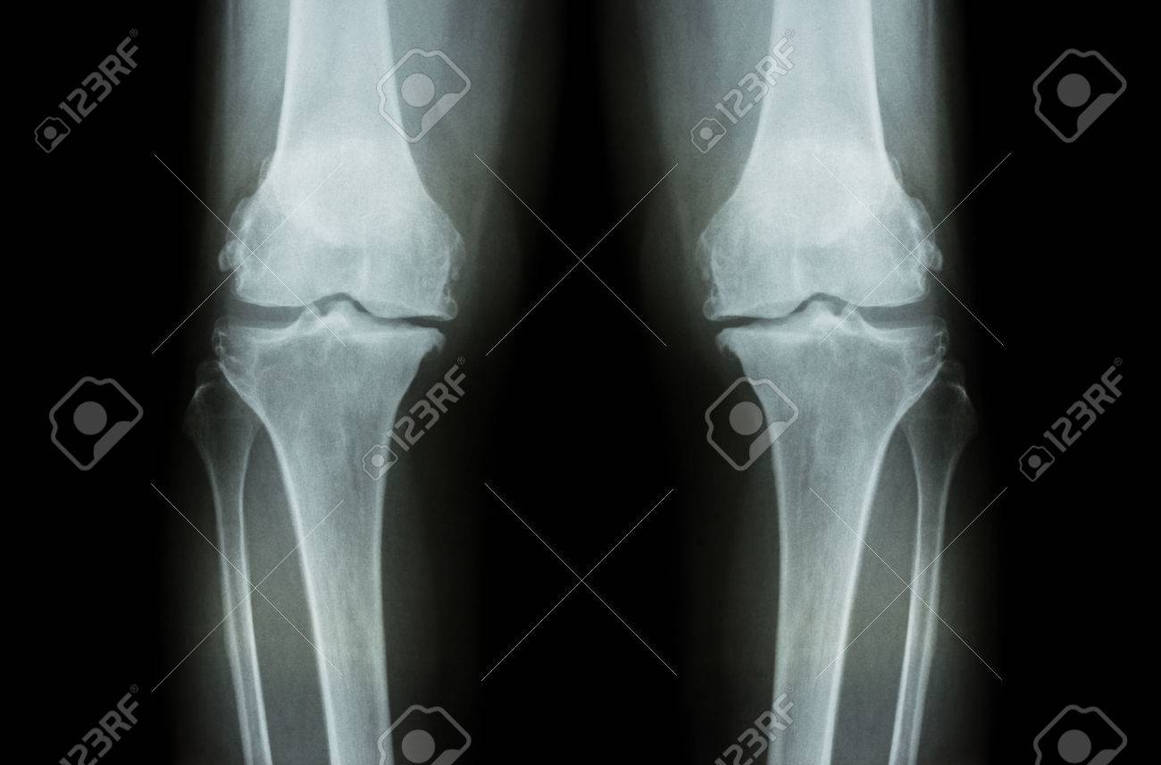 Osteoarthritis Knee ( OA Knee ). Film x-ray both knee ( front view ) show narrow joint space ( joint cartilage loss ) , osteophyte , subchondral sclerosis - 46036212 Osteoarthritis Knee ( OA Knee ). Film x-ray both knee ( front view ) show narrow joint space ( joint cartilage loss ) , osteophyte , subchondral sclerosis - 46036212